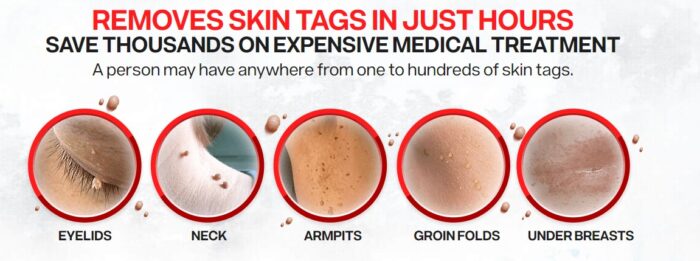 Skin tag removal